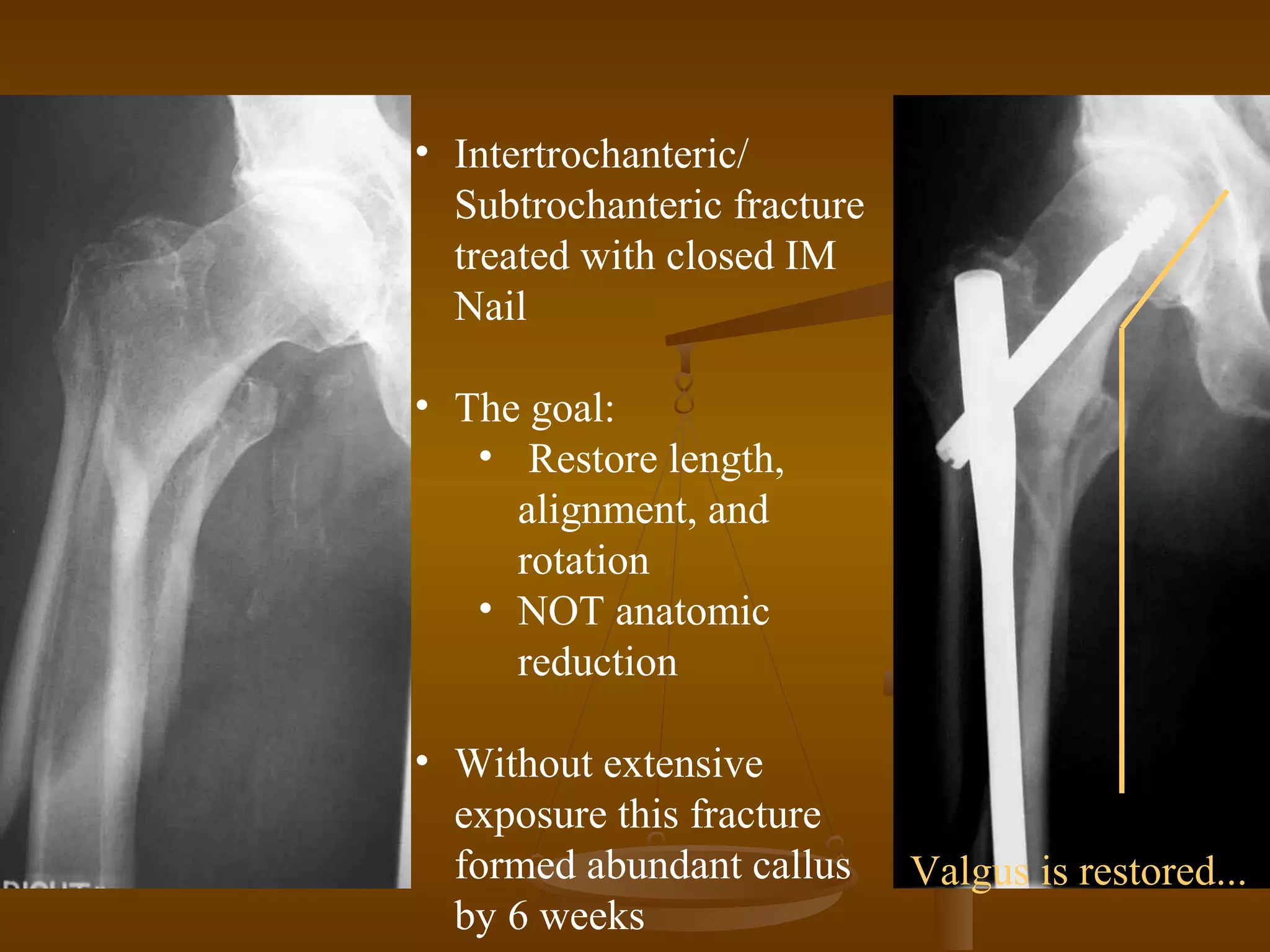 • Intertrochanteric/
Subtrochanteric fracture
treated with closed IM
Nail
• The goal:
• Restore length,
alignment, and
rotation
• NOT anatomic
reduction
• Without extensive
exposure this fracture
formed abundant callus
by 6 weeks
Valgus is restored...
 