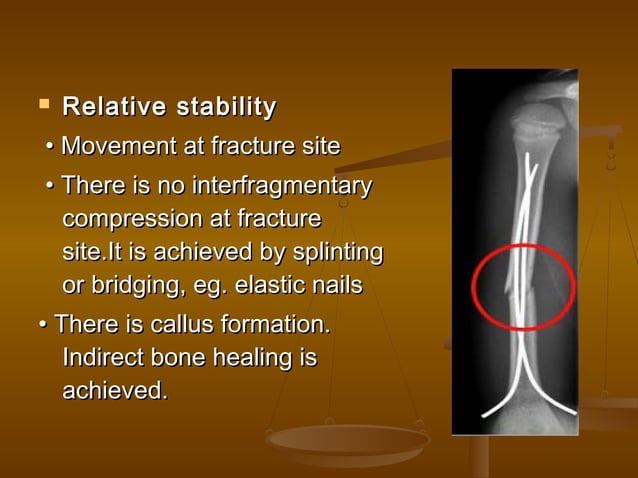 AO Principles of Fracture treatment & Different Implants. | PPT