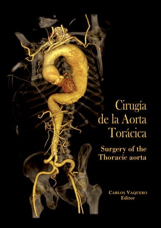 12:43

Página 1

ISBN: 978-84-614-5662-8

CARLOS VAQUERO. Editor

2/12/10

Cirugía
de la Aorta
Torácica
Surgery of the
Thoracic aorta
Cirugía de la Aorta Torácica

CUBIERTA CIRUGIA TORACICA

C ARLOS V AQUERO
Editor

 