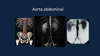 Aorta abdominal
 