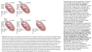Hemodynamics of aortic regurgitation. A, Normal
conditions. B, The hemodynamic changes that
occur in severe acute aortic regurgitation.
Although total stroke volume is increased, forward
stroke volume is reduced. Left ventricular end-
diastolic pressure (LVEDP) rises dramatically. C,
Hemodynamic changes occurring in chronic
compensated aortic regurgitation are shown.
Eccentric hypertrophy produces increased end-
diastolic volume (EDV), which permits an increase
in total, as well as forward, stroke volume. The
volume overload is accommodated, and left
ventricular filling pressure is normalized.
Ventricular emptying and end-systolic volume
(ESV) remain normal. D, In chronic
decompensated aortic regurgitation, impaired left
ventricular emptying produces an increase in end-
systolic volume and a fall in ejection fraction (EF),
total stroke volume, and forward stroke volume.
There is further cardiac dilation and reelevation of
left ventricular filling pressure. E, Immediately
following valve replacement, preload estimated
by EDV decreases, as does filling pressure. ESV
also is decreased, but to a lesser extent. The
result is an initial fall in EF. Despite these
changes, elimination of regurgitation leads to an
increase in forward stroke volume, and with
time ejection fraction increases. Aop = aortic
pressure; RF = regurgitant fraction.
(From Carabello BA: Aortic regurgitation:
Hemodynamic determinants of prognosis. In Cohn
LH, DiSesa VJ [eds]: Aortic Regurgitation:
Medical and Surgical Management. New York,
Marcel Dekker, 1986, p 99-101.)
 