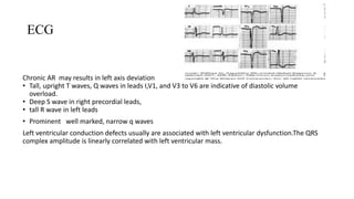 ECG
Chronic AR may results in left axis deviation
• Tall, upright T waves, Q waves in leads I,V1, and V3 to V6 are indicative of diastolic volume
overload.
• Deep S wave in right precordial leads,
• tall R wave in left leads
• Prominent well marked, narrow q waves
Left ventricular conduction defects usually are associated with left ventricular dysfunction.The QRS
complex amplitude is linearly correlated with left ventricular mass.
 