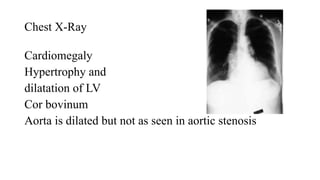 Chest X-Ray
Cardiomegaly
Hypertrophy and
dilatation of LV
Cor bovinum
Aorta is dilated but not as seen in aortic stenosis
 