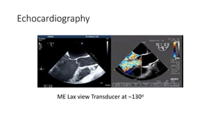 Echocardiography
ME Lax view Transducer at 130o
 