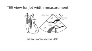 TEE view for jet width measurement
ME Lax view Transducer at 130o
 