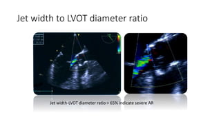 Jet width to LVOT diameter ratio
Jet width-LVOT diameter ratio > 65% indicate severe AR
 