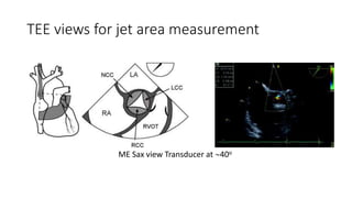 TEE views for jet area measurement
ME Sax view Transducer at 40o
 