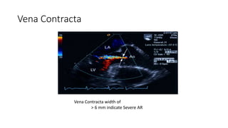 Vena Contracta
Vena Contracta width of
> 6 mm indicate Severe AR
 