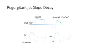 Regurgitant jet Slope Decay
Ao
LV pressure
CWD LVOT
Mild AR Severe AR (>3m/sec2)
Ao
LV
 