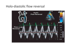 Holo-diastolic flow reversal
Severe AR
 