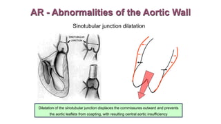 Sinotubular junction dilatation
Dilatation of the sinotubular junction displaces the commissures outward and prevents
the aortic leaflets from coapting, with resulting central aortic insufficiency
AR - Abnormalities of the Aortic Wall
 