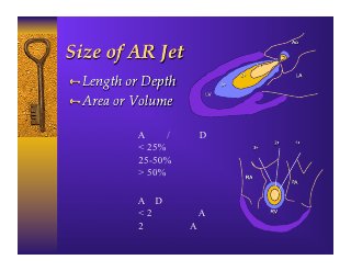 Severity   AR Jet/LVOT Diameter
Mild       < 25%
Mod        25-50%
Severe     > 50%

Severity   AR Depth
Mild       < 2 cm below AV
Mod        2 cm below AL of MV
Severe     Jet to Pap Ms
 