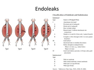 Endoleaks
 
