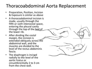 Thoracoabdominal Aorta Replacement
• Preparation, Position, Incision
& Exposure is similar as above
• A thoracoabdominal incision is
made, usually through the
fifth or sixth intercostal space,
entering the pleural cavity
through the top of the bed of
the lower rib.
• After dividing the costal
margin, the incision is
extended obliquely across the
abdominal wall, and the
muscles are divided to the
level of the rectus abdominis
fascia.
• The diaphragm is incised
radially to the level of the
aortic hiatus or
circumferentially 2 to 3 cm
from the chest wall.
 