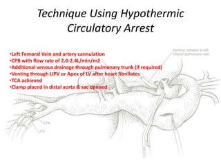 Technique Using Hypothermic
Circulatory Arrest
•Left Femoral Vein and artery cannulation
•CPB with flow rate of 2.0-2.4L/min/m2
•Additional venous drainage through pulmonary trunk (if required)
•Venting through LIPV or Apex of LV after heart fibrillates
•TCA achieved
•Clamp placed in distal aorta & sac opened
 