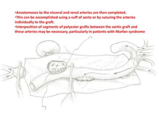 •Anastomoses to the visceral and renal arteries are then completed.
•This can be accomplished using a cuff of aorta or by suturing the arteries
individually to the graft.
•Interposition of segments of polyester grafts between the aortic graft and
these arteries may be necessary, particularly in patients with Marfan syndrome
 