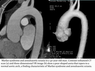 Marfan syndrome and annuloaortic ectasia in a 40-year-old man. Contrast-enhanced CT
scan (a) and three-dimensional VR image (b) show a pear-shaped aorta that tapers to a
normal aortic arch, a finding characteristic of Marfan syndrome and annuloaortic ectasia.
 