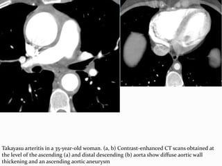 Takayasu arteritis in a 35-year-old woman. (a, b) Contrast-enhanced CT scans obtained at
the level of the ascending (a) and distal descending (b) aorta show diffuse aortic wall
thickening and an ascending aortic aneurysm
 