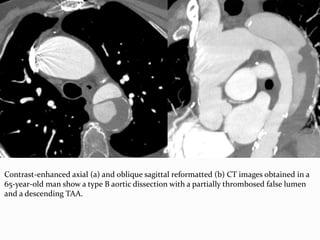 Contrast-enhanced axial (a) and oblique sagittal reformatted (b) CT images obtained in a
65-year-old man show a type B aortic dissection with a partially thrombosed false lumen
and a descending TAA.
 