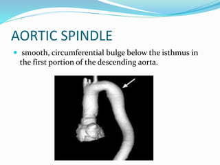 AORTIC SPINDLE
 smooth, circumferential bulge below the isthmus in
the first portion of the descending aorta.
 
