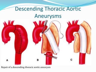 Descending Thoracic Aortic
Aneurysms
Repair of a descending thoracic aortic aneurysm
 
