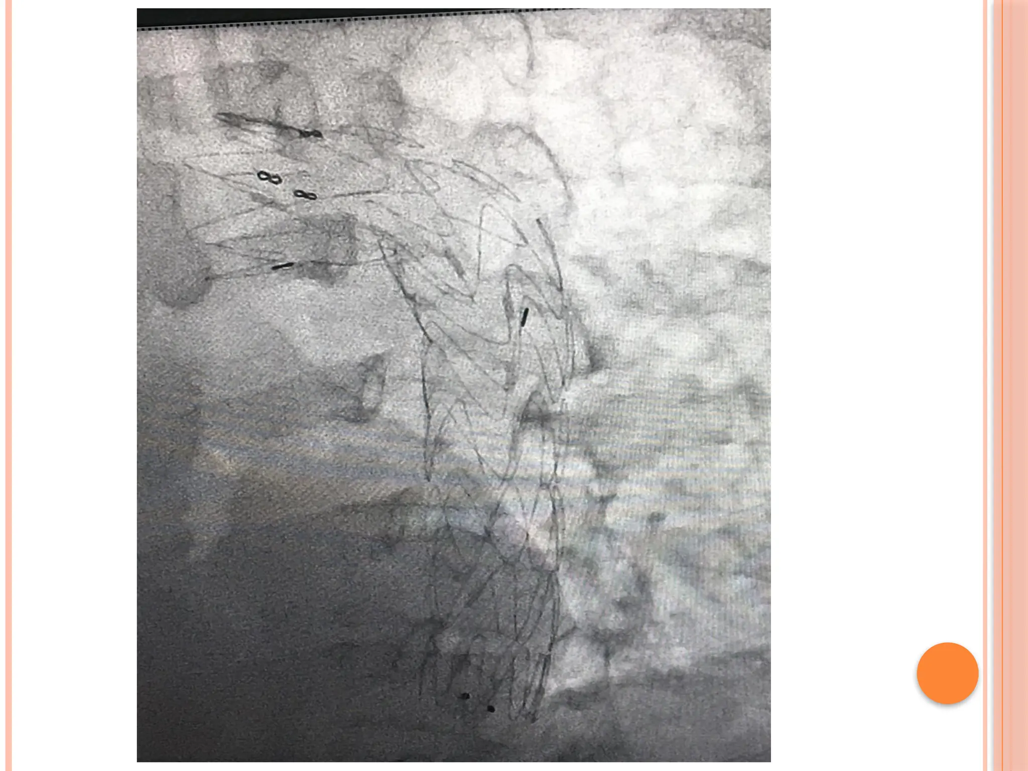 Aortic aneurysm basic, types and management