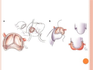 Aortic aneurysm basic, types and management | PPT