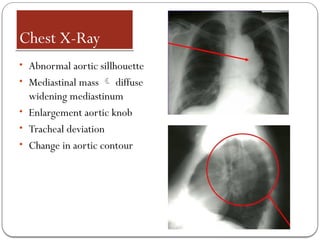 Chest X-Ray
• Abnormal aortic sillhouette
• Mediastinal mass  diffuse
widening mediastinum
• Enlargement aortic knob
• Tracheal deviation
• Change in aortic contour
 