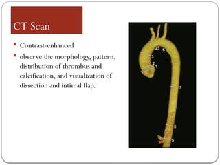 CT Scan
 Contrast-enhanced
 observe the morphology, pattern,
distribution of thrombus and
calcification, and visualization of
dissection and intimal flap.
 