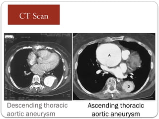 Descending thoracic
aortic aneurysm
CT Scan
Ascending thoracic
aortic aneurysm
 