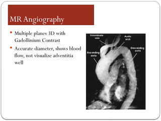 MRAngiography
 Multiple planes 3D with
Gadollinium Contrast
 Accurate diameter, shows blood
flow, not visualize adventitia
well
 