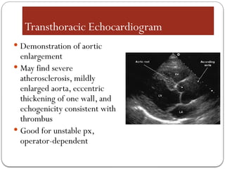 Transthoracic Echocardiogram
 Demonstration of aortic
enlargement
 May find severe
atherosclerosis, mildly
enlarged aorta, eccentric
thickening of one wall, and
echogenicity consistent with
thrombus
 Good for unstable px,
operator-dependent
 
