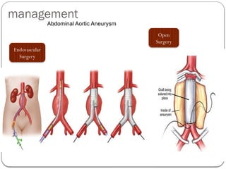 management
Abdominal Aortic Aneurysm
Open
Surgery
Endovascular
Surgery
 