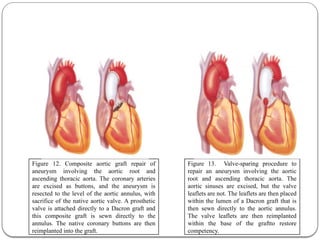 Figure 13. Valve-sparing procedure to
repair an aneurysm involving the aortic
root and ascending thoracic aorta. The
aortic sinuses are excised, but the valve
leaflets are not. The leaflets are then placed
within the lumen of a Dacron graft that is
then sewn directly to the aortic annulus.
The valve leaflets are then reimplanted
within the base of the graftto restore
competency.
Figure 12. Composite aortic graft repair of
aneurysm involving the aortic root and
ascending thoracic aorta. The coronary arteries
are excised as buttons, and the aneurysm is
resected to the level of the aortic annulus, with
sacrifice of the native aortic valve. A prosthetic
valve is attached directly to a Dacron graft and
this composite graft is sewn directly to the
annulus. The native coronary buttons are then
reimplanted into the graft.
 