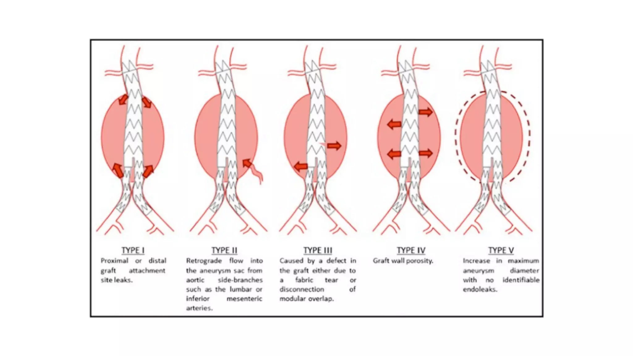 Aortic Aneurysm.pdf