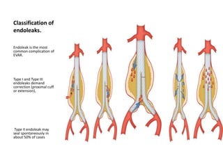 Evar Classification Aortic aneurysm dr jeevraj | PPTX