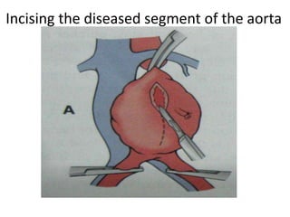 Incising the diseased segment of the aorta
 