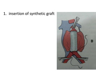 1. insertion of synthetic graft
 