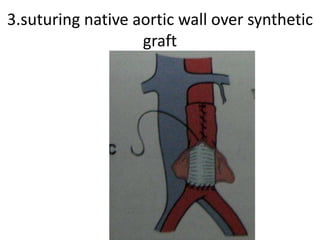 3.suturing native aortic wall over synthetic
                   graft
 
