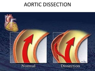 AORTIC DISSECTION
 