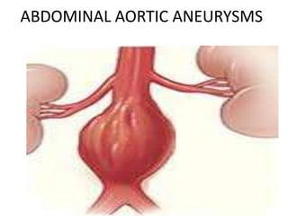 ABDOMINAL AORTIC ANEURYSMS
 