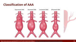 Aortic Aneurysm Rethinking the Aorta as a Dynamic Organ.pptx