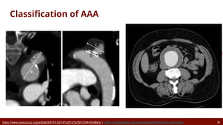 Aortic Aneurysm Rethinking the Aorta as a Dynamic Organ.pptx