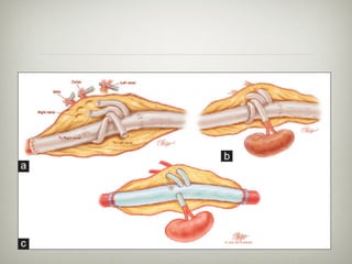 Taaa Incision Aortic aneurysms and dissection 2016 | PDF