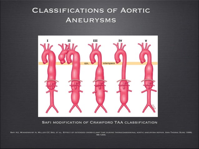 Aortic aneurysms and dissection 2016 | PDF | Heart and Cardiovascular ...