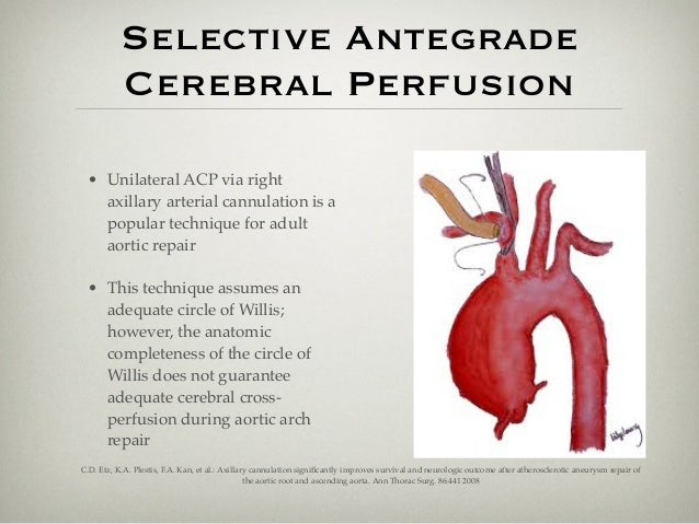 aortic aneurysms and dissection