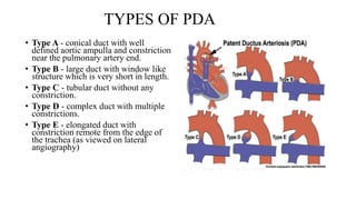 TYPES OF PDA
• Type A - conical duct with well
defined aortic ampulla and constriction
near the pulmonary artery end.
• Type B - large duct with window like
structure which is very short in length.
• Type C - tubular duct without any
constriction.
• Type D - complex duct with multiple
constrictions.
• Type E - elongated duct with
constriction remote from the edge of
the trachea (as viewed on lateral
angiography)
 