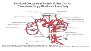 Post-ductal Coarctation of the Aorta Utilizes Collateral
Circulation to Supply Blood to the Lower Body
 