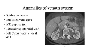 Anomalies of venous system
• Double vena cava
• Left sided vena cava
• IVC duplication
• Retro aortic left renal vein
• Left Circum-aortic renal
vein
 