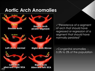 Arching Defect Aortic arch anomalies | PDF